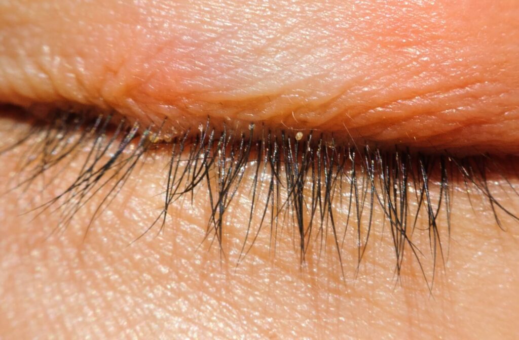 Extreme close-up of flakes building up at the base of a person's eyelids.