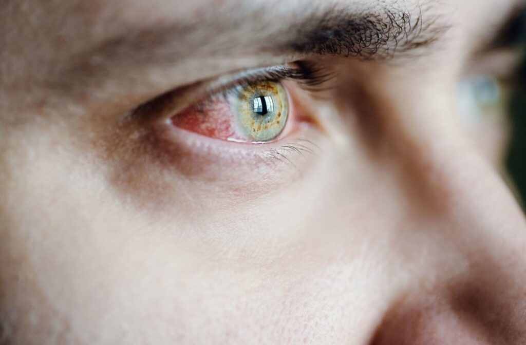 Close-up of a green eye with visible redness and irritation on the inner corner.